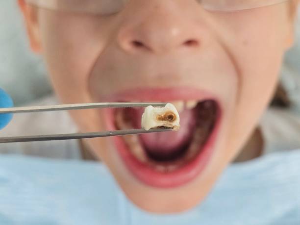 Best Emergency Dental Extractions in Box Elder, SD